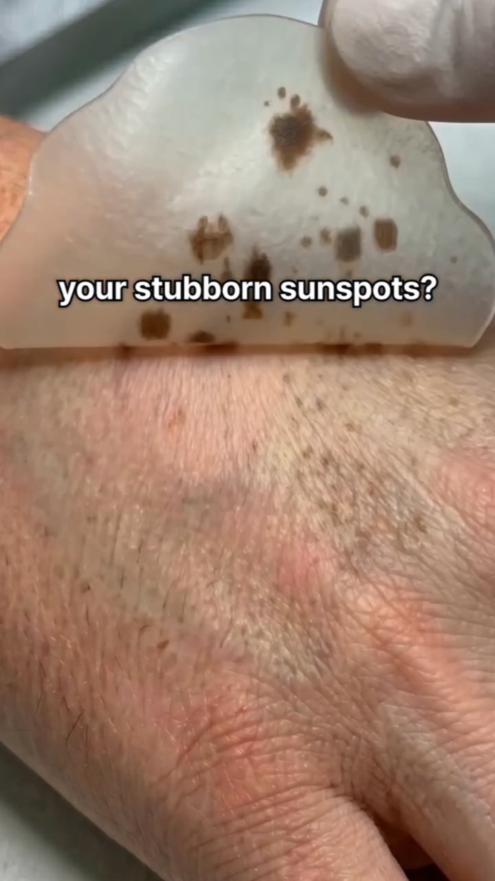 Extreme close-up of a sun-spotted hand with a translucent patch peeled back to show dark spots, captioned “your stubborn sunspots?”
