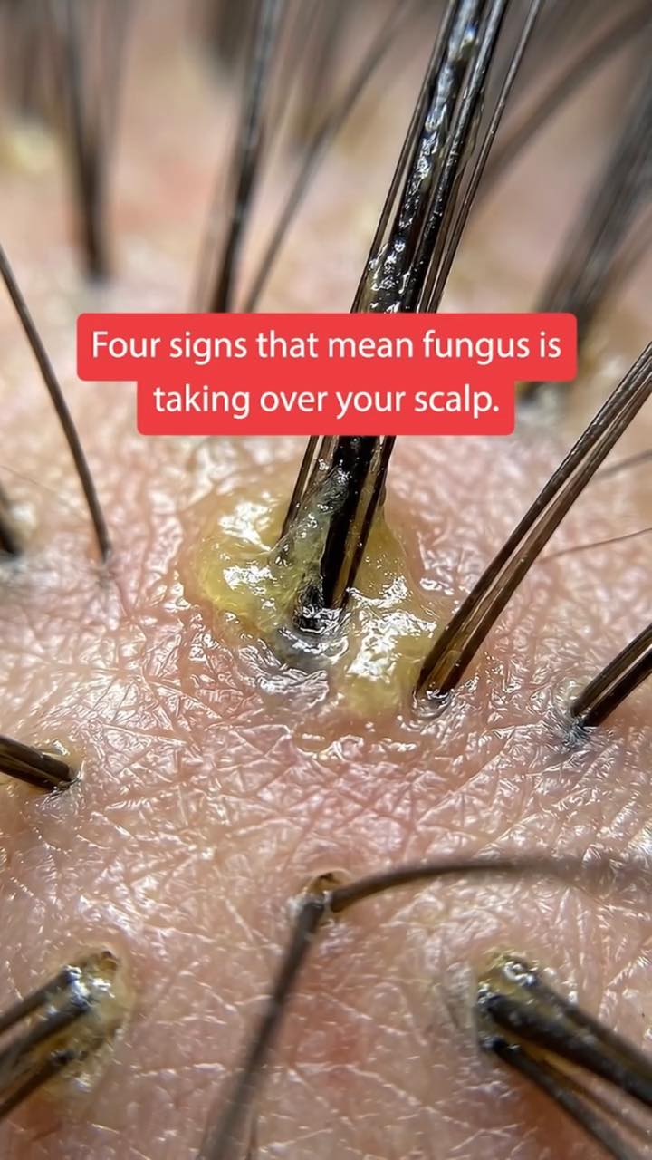 Extreme close-up of hair follicles on a flaky scalp under a red caption reading “Four signs that mean fungus is taking over your scalp.”