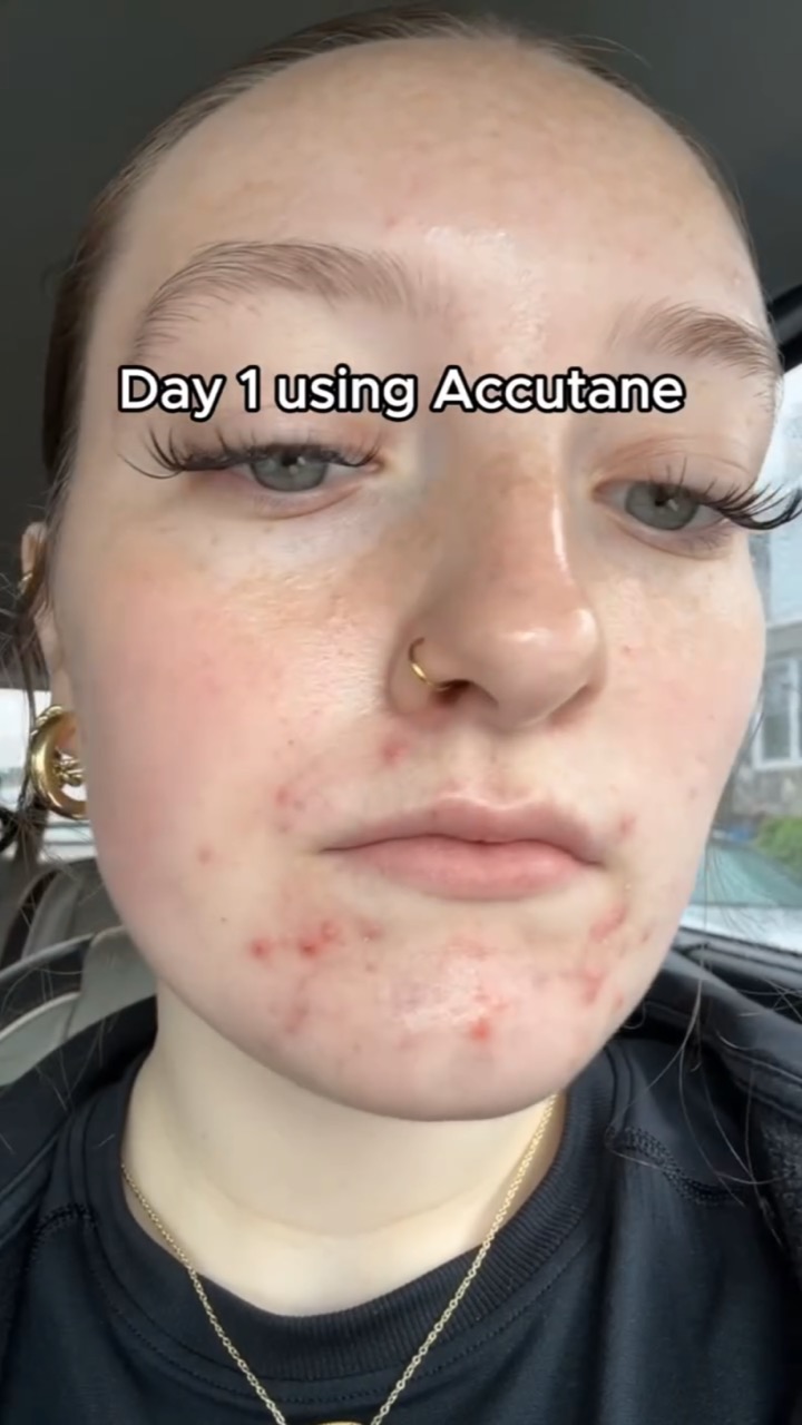 Close-up car selfie of a young woman with inflamed acne on her chin and cheeks, captioned “Day 1 using Accutane”